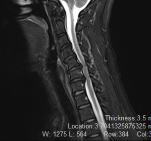 頸椎MRI2